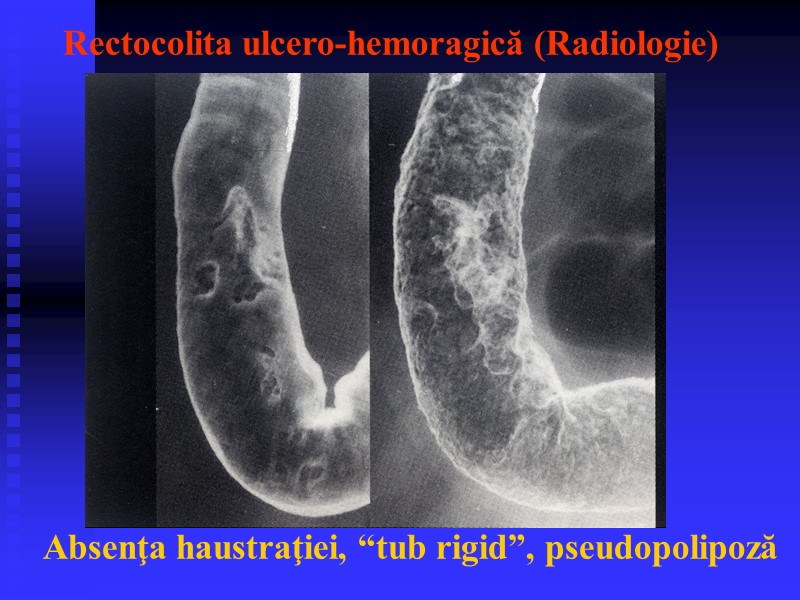 Rectocolita ulcero-hemoragică (Radiologie) Absenţa haustraţiei, “tub rigid”, pseudopolipoză